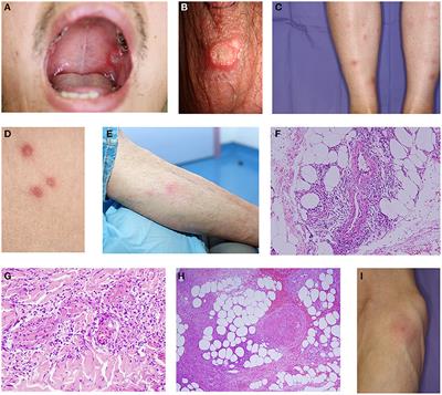 Mucocutaneous Manifestations of Behçet's Disease